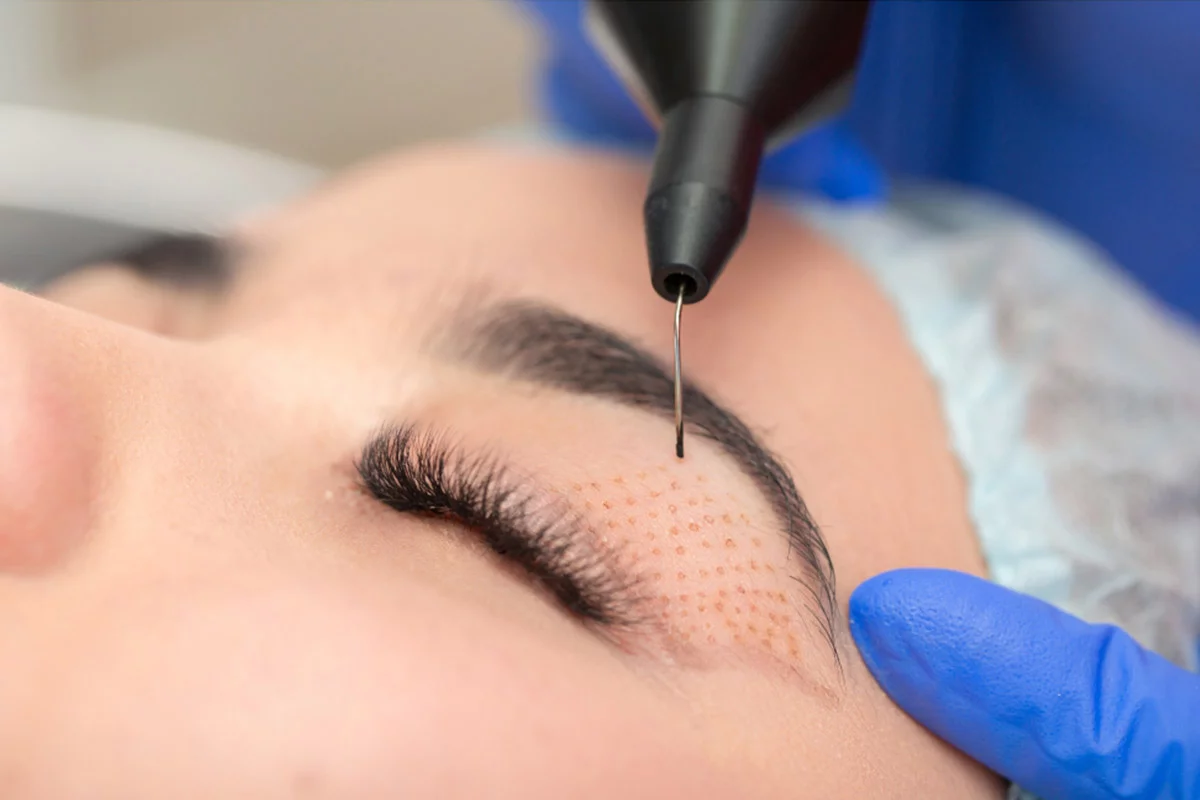 Plasma Pen Treatment in Cape Town | Skin Tightening Treatment